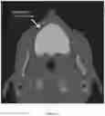 Fig. 17 - REDUCTION SPLINT FOR EDENTULOUS PATIENTS