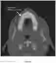 Fig. 18 - REDUCTION SPLINT FOR EDENTULOUS PATIENTS