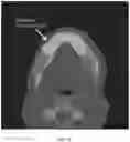 Fig. 19 - REDUCTION SPLINT FOR EDENTULOUS PATIENTS