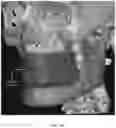 Fig. 20 - REDUCTION SPLINT FOR EDENTULOUS PATIENTS