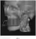 Fig. 21 - REDUCTION SPLINT FOR EDENTULOUS PATIENTS