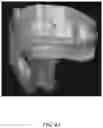Fig. 22 - REDUCTION SPLINT FOR EDENTULOUS PATIENTS
