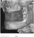 Fig. 24 - REDUCTION SPLINT FOR EDENTULOUS PATIENTS