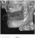 Fig. 25 - REDUCTION SPLINT FOR EDENTULOUS PATIENTS
