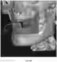 Fig. 26 - REDUCTION SPLINT FOR EDENTULOUS PATIENTS