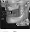 Fig. 27 - REDUCTION SPLINT FOR EDENTULOUS PATIENTS