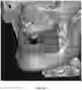 Fig. 29 - REDUCTION SPLINT FOR EDENTULOUS PATIENTS