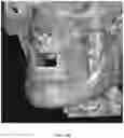 Fig. 30 - REDUCTION SPLINT FOR EDENTULOUS PATIENTS