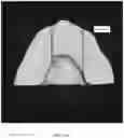 Fig. 32 - REDUCTION SPLINT FOR EDENTULOUS PATIENTS