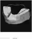 Fig. 35 - REDUCTION SPLINT FOR EDENTULOUS PATIENTS