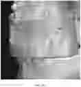 Fig. 38 - REDUCTION SPLINT FOR EDENTULOUS PATIENTS
