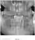 Fig. 49 - REDUCTION SPLINT FOR EDENTULOUS PATIENTS