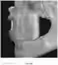 Fig. 50 - REDUCTION SPLINT FOR EDENTULOUS PATIENTS