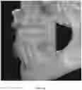 Fig. 51 - REDUCTION SPLINT FOR EDENTULOUS PATIENTS