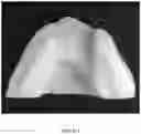 Fig. 53 - REDUCTION SPLINT FOR EDENTULOUS PATIENTS