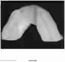 Fig. 54 - REDUCTION SPLINT FOR EDENTULOUS PATIENTS