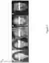 Fig. 06 - Assessment of facial paralysis and gaze deviation