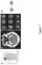 Fig. 08 - Assessment of facial paralysis and gaze deviation