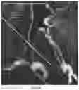 Fig. 12 - SYSTEMS AND PHARMACEUTICAL COMPOSITIONS FOR TREATMENT BY DIRECT INJECTION OF A TARGETED POPULATION OF CELLS