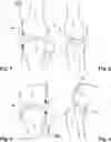 Fig. 02 - Tensioner-balancer for knee joint