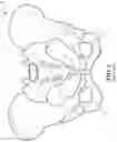 Fig. 02 - STACKABLE LIFT FOR ISCHIAL TUBEROSITY RE-ALIGNMENT OF  SACRAL/LUMBAR COMPLEX AND METHOD OF USE