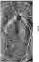 Fig. 07 - SYSTEMS AND METHODS FOR SELF-TRACKING REAL-TIME HIGH RESOLUTION WIDE-FIELD OPTICAL COHERENCE TOMOGRAPHY ANGIOGRAPHY