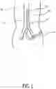 Fig. 02 - Artificial kidney to support a concept of digital dialysis (CDD)