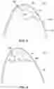 Fig. 05 - Backwall strike braze repair