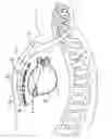 Fig. 01 - Implantable extravascular electrical stimulation lead having improved sensing and pacing capability