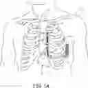 Fig. 02 - Implantable extravascular electrical stimulation lead having improved sensing and pacing capability