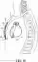 Fig. 03 - Implantable extravascular electrical stimulation lead having improved sensing and pacing capability