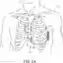 Fig. 04 - Implantable extravascular electrical stimulation lead having improved sensing and pacing capability