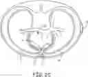 Fig. 06 - Implantable extravascular electrical stimulation lead having improved sensing and pacing capability