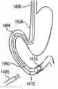 Fig. 01 - SURGICAL DEVICES, SYSTEMS, AND METHODS USING FIDUCIAL IDENTIFICATION AND TRACKING