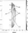 Fig. 72 - Catheter with shock wave electrodes aligned on longitudinal axis