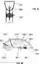 Fig. 85 - Catheter with shock wave electrodes aligned on longitudinal axis