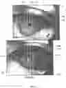 Fig. 04 - METHODS, SYSTEMS, PROGRAMS AND DEVICES TO PREDICT PATIENT OUTCOME USING DIFFERENTIAL IN PUPILLARY INDEX