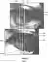 Fig. 05 - METHODS, SYSTEMS, PROGRAMS AND DEVICES TO PREDICT PATIENT OUTCOME USING DIFFERENTIAL IN PUPILLARY INDEX