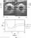 Fig. 07 - METHODS, SYSTEMS, PROGRAMS AND DEVICES TO PREDICT PATIENT OUTCOME USING DIFFERENTIAL IN PUPILLARY INDEX