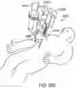 Fig. 31 - SIDE LOOKING MINIMALLY INVASIVE SURGERY INSTRUMENT ASSEMBLY
