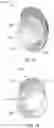 Fig. 02 - MOBILE BEARING ANATOMIC GLENOID