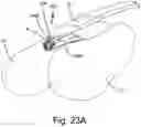 Fig. 34 - Resilient body component contact for a subcutaneous device