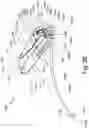 Fig. 45 - Resilient body component contact for a subcutaneous device