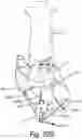 Fig. 53 - Resilient body component contact for a subcutaneous device