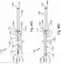 Fig. 76 - Resilient body component contact for a subcutaneous device