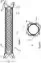Fig. 02 - Stent and stent delivery device