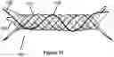 Fig. 08 - Stent and stent delivery device