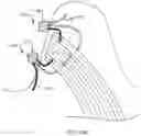 Fig. 22 - METHOD OF SOFT ANCHOR KNOTLESS REPAIR
