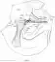 Fig. 24 - METHOD OF SOFT ANCHOR KNOTLESS REPAIR