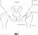 Fig. 02 - Hip surgery systems and methods